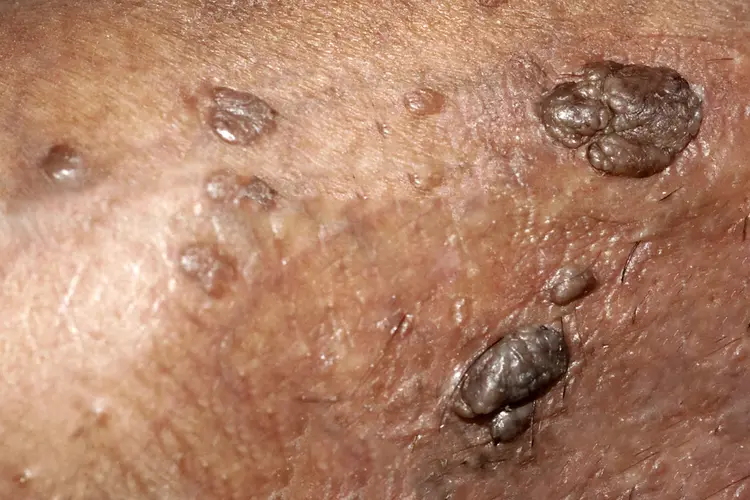 HPV Symptoms